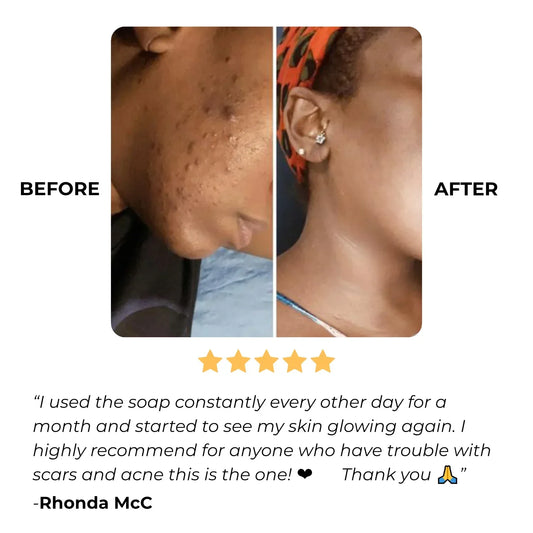 Turmeric & Kojic Acid Brightening Soap