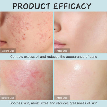 Tea Tree Salicylic Acid Oil Control Acne Removal Set-Prevent Rebound