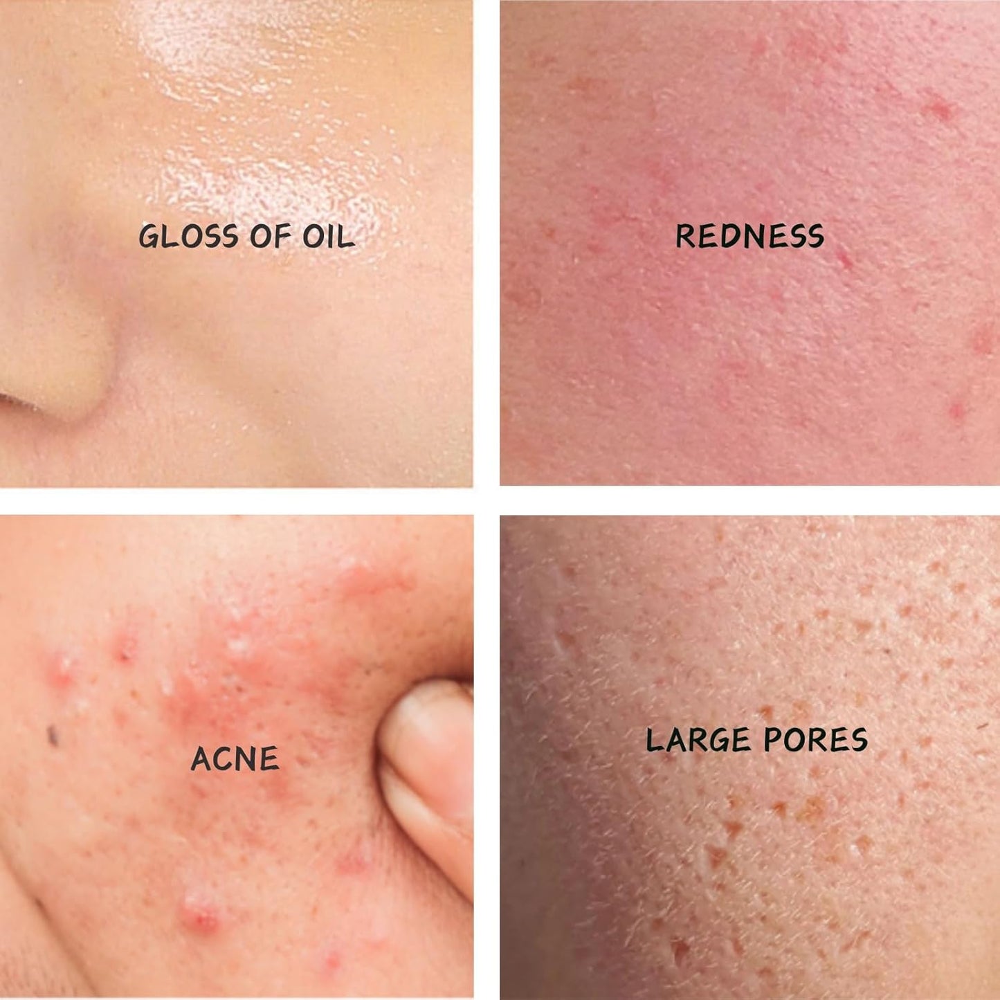 Tea Tree Salicylic Acid Oil Control Acne Removal Set-Prevent Rebound