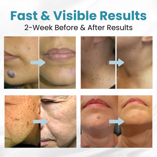 Pimple & Scar Solution: 2% Salicylic Exfoliant + High-Potency VC Essence