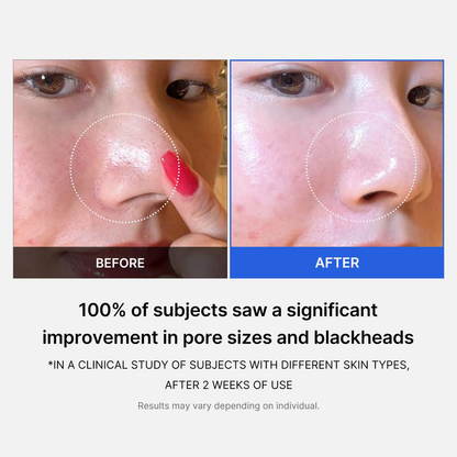 Mirco Pore Pads (AHA + BHA) |Acne-prone skin care